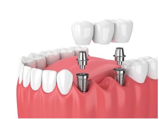 Dentist Supports